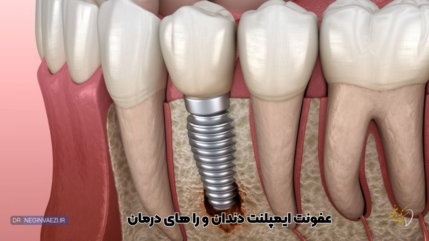 عفونت ایمپلنت دندان، از کجا بفهمیم ایمپلنت عفونت کرده است,جلوگیری از عفونت ایمپلنت دندان