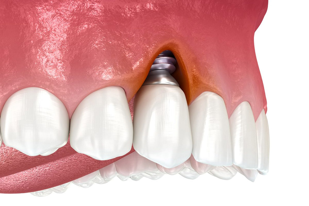 عفونت و التهاب لثه و تحلیل استخوان بعد از ایمپلنت