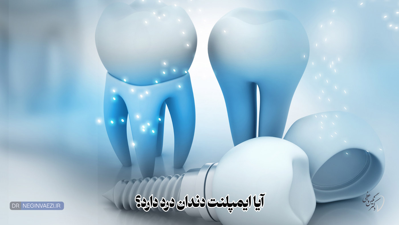 درد بعد از ایمپلنت دندان، کاشت ایمپلنت بدون درد، کاهش درد ایمپلنت، درد ایمپلنت تا چند روز، آیا ایمپلنت دندان درد دارد؟