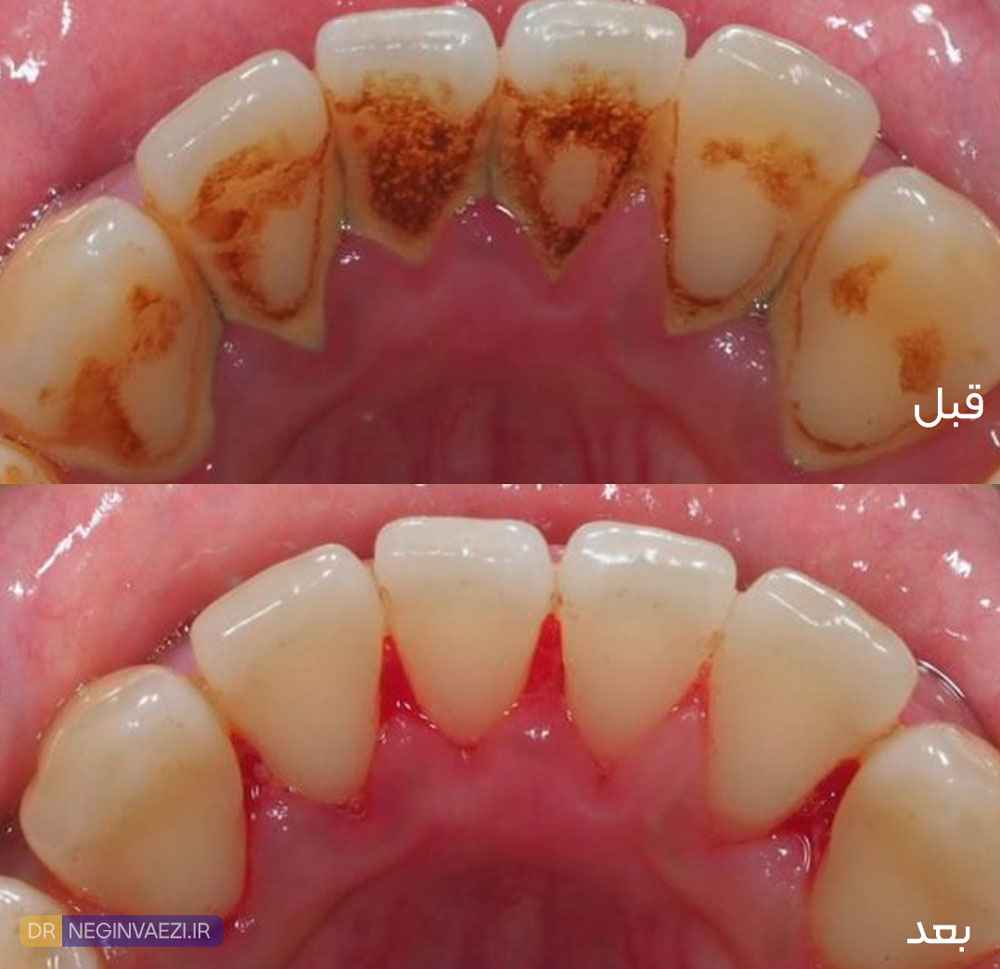 نمونه ای قبل و بعد جرم گیری دندان و تغییری که بعد از آن مشاهده می شود 