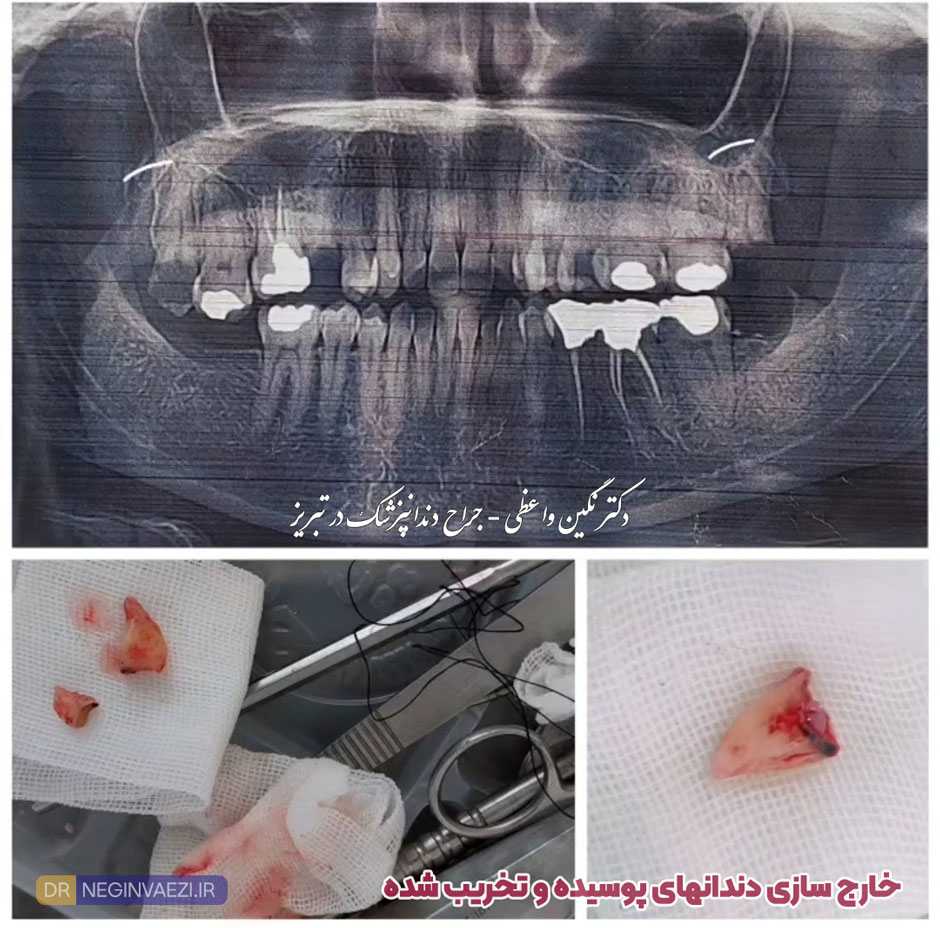 عکس کشیدن دندان پوسیده و بشدت تخریب شده   دکتر نگین واعظی