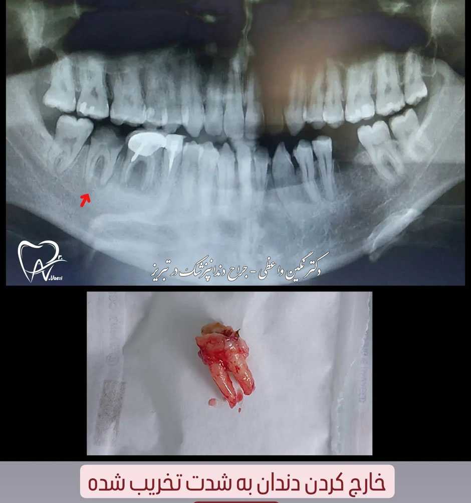 نمونه کار کشیدن دندان بشدت تخریب شده توسط دکتر نگین واعظی   تبریز