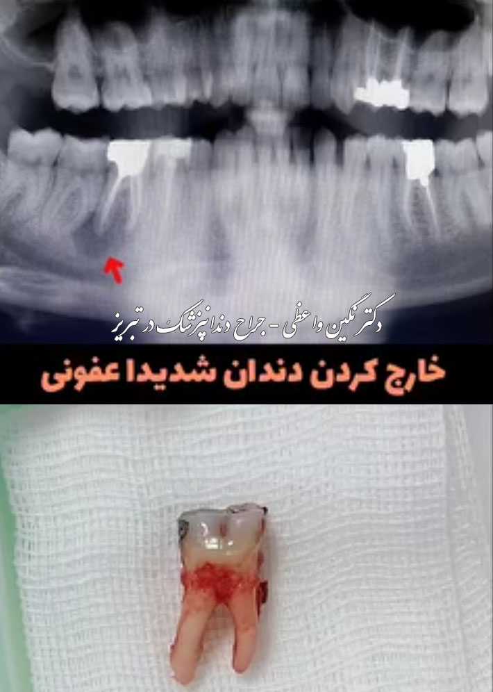 عکس کشیدن دندان عفونت کرده   کشیدن دندان کاملا عفونی   دکتر نگین واعظی