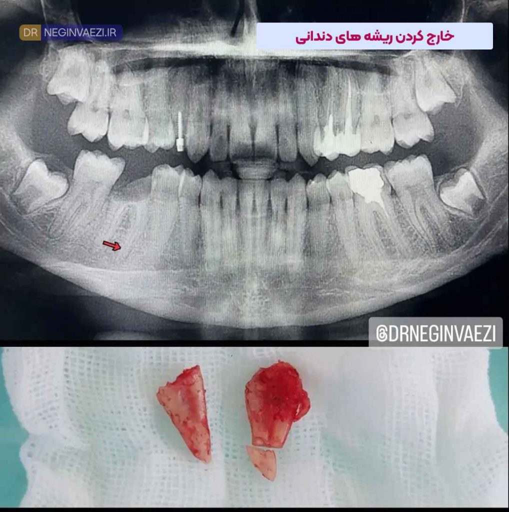 خارج کردن ریشه های دندانی دکتر نگین واعظی تبریز 1018x1024