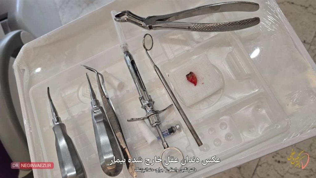 عکس دندان عقل بالا بعد از کشیدن   دکتر نگین واعظی