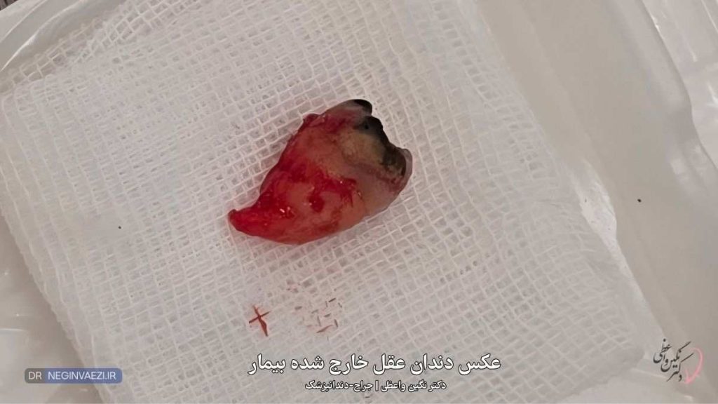 عکس دندان عقل کشیده شده   دکتر نگین واعظی   تبریز