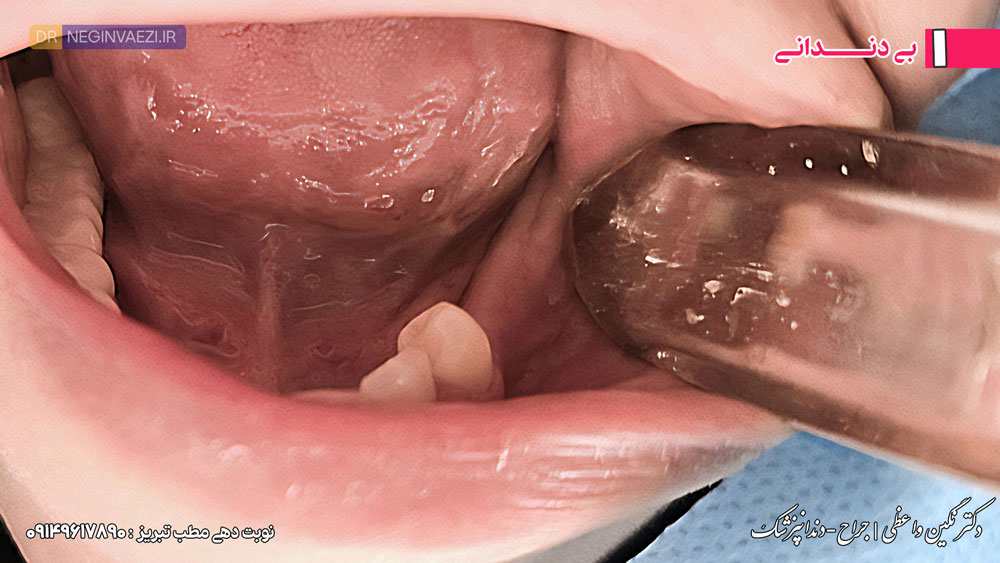 مراحل کاشت ایمپلنت - نمونه کار ایمپلنت فک پایین - مرحله بی دندانی