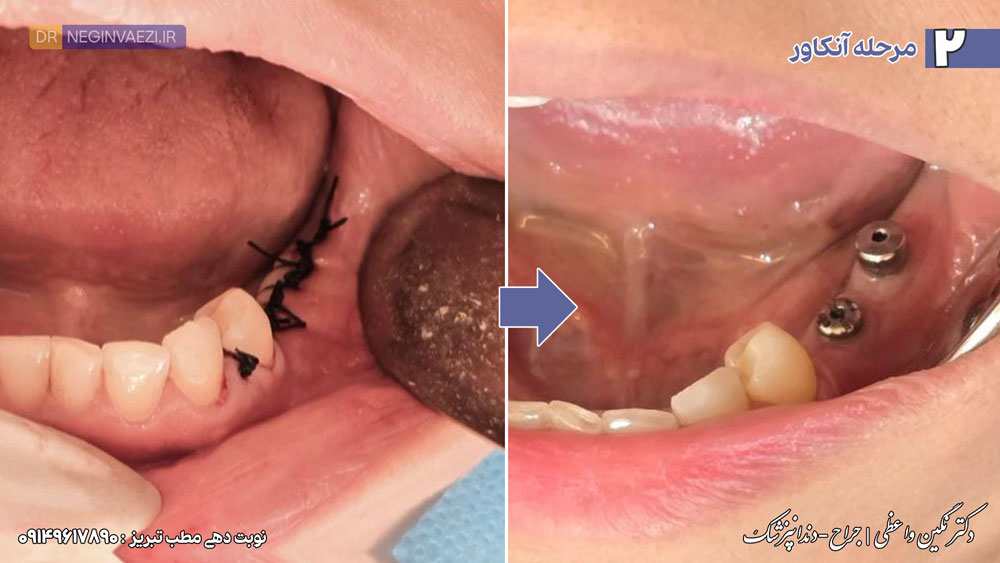 پس از کاشت پایه ایمپلنت، بعد از مدت مشخصی ایمپلنت آنکاور می شود.