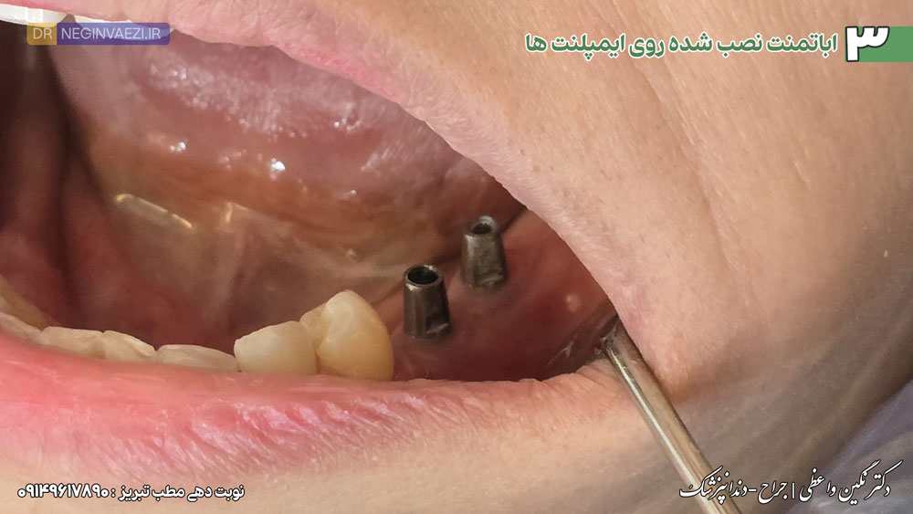 مرحله قالب گیری و نصب اباتمنت مراحل بعدی می باشد 
