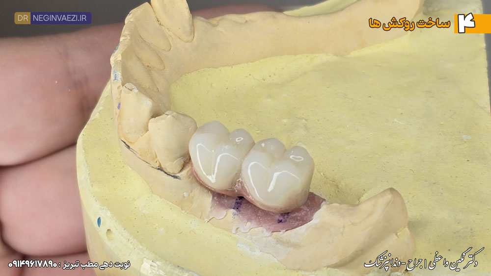 ساخت روکش ایمپلنت