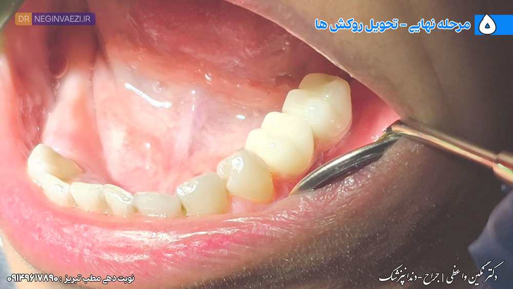 امتحان و تحویل روکش های نهایی ایمپلنت به بیمار