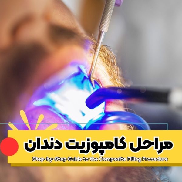 مراحل کامپوزیت دندان روش انجام کامپوزیت دندان فرایند کامپوزیت دندان کامپوزیت چگونه انجام می‌شود مراحل ترمیم دندان با کامپوزیت مراحل لایه‌گذاری کامپوزیت
