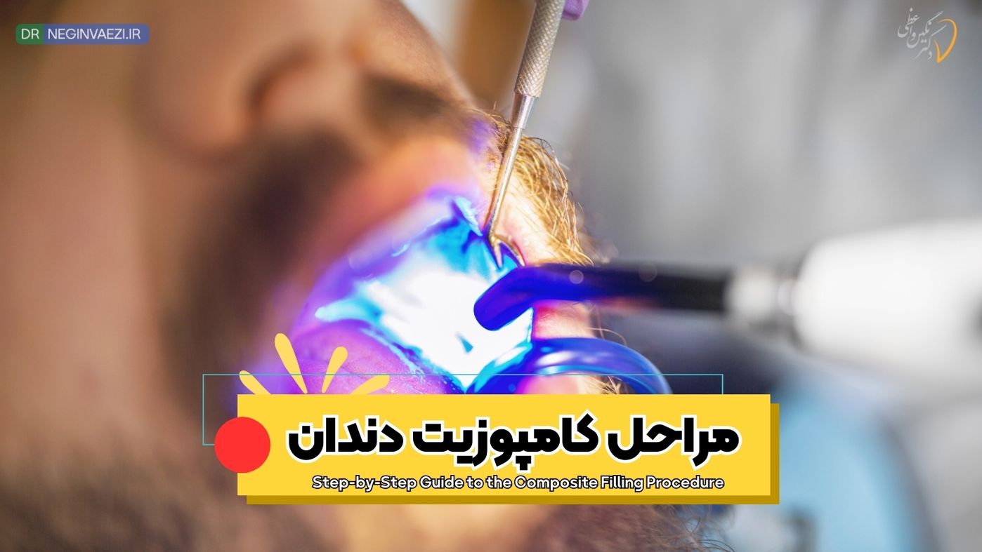 مراحل کامپوزیت دندان روش انجام کامپوزیت دندان فرایند کامپوزیت دندان کامپوزیت چگونه انجام می‌شود مراحل ترمیم دندان با کامپوزیت مراحل لایه‌گذاری کامپوزیت