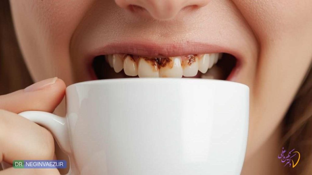 کاهش مصرف نوشدنی رنگ زا مانند قهوه باعث افزایش عمر کامپوزیت و جلوگیری از تغییر رنگ آن می شود.