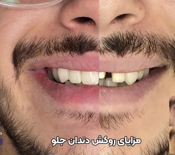 مزایا و فواید روکش دندان جلو با pfm و تمام سرامیکی زیرکونیا در تبریز دکتر نگین واعظی ولیعصر