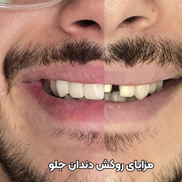 مزایا و فواید روکش دندان جلو با pfm و تمام سرامیکی زیرکونیا در تبریز دکتر نگین واعظی ولیعصر