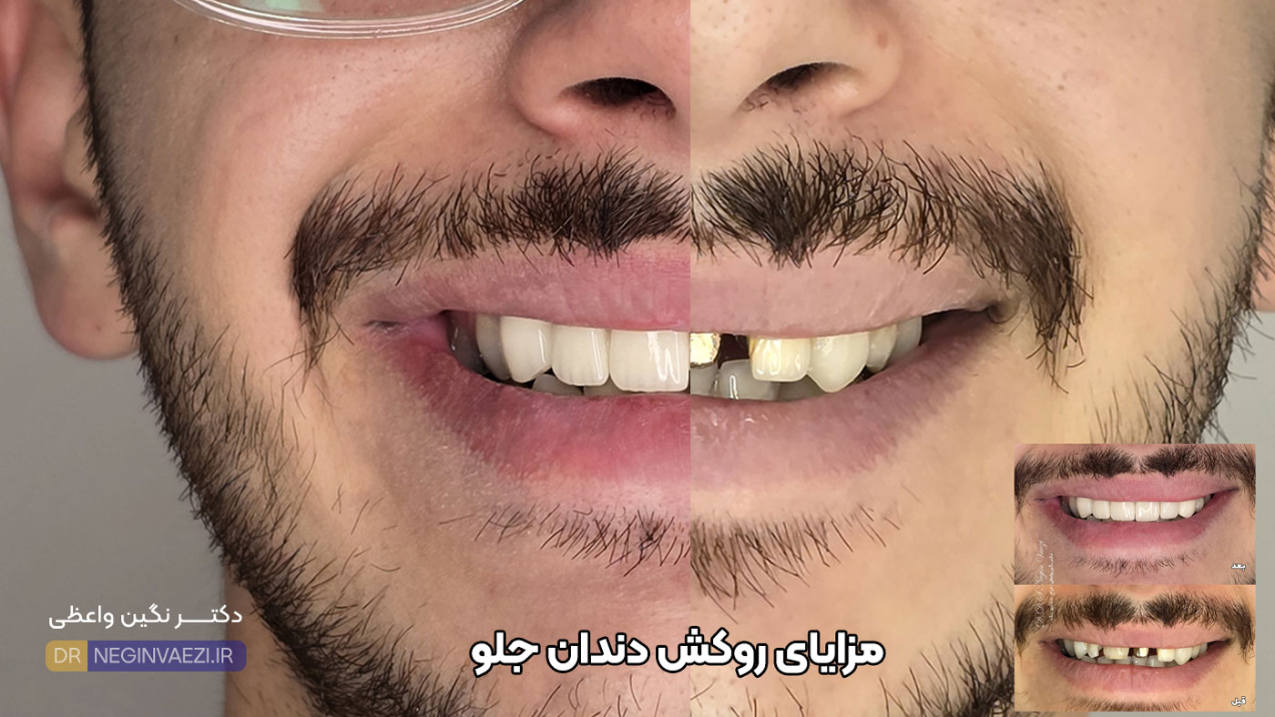 مزایا و فواید روکش دندان جلو با pfm و تمام سرامیکی زیرکونیا در تبریز دکتر نگین واعظی ولیعصر