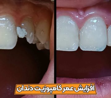 نکات مهم افزایش عمر کامپوزیت و جلوگیری از تغییر رنگ و شکستگی و لب پرشدگی آن