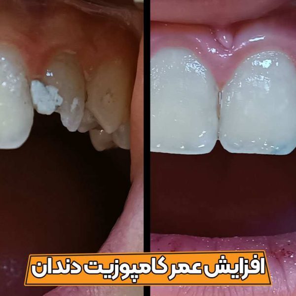 نکات مهم افزایش عمر کامپوزیت و جلوگیری از تغییر رنگ و شکستگی و لب پرشدگی آن