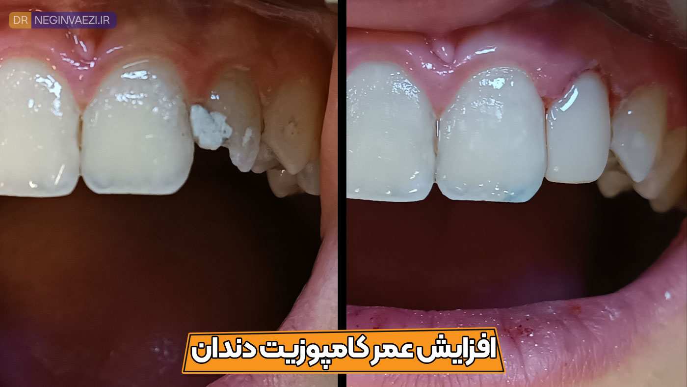 نکات مهم افزایش عمر کامپوزیت و جلوگیری از تغییر رنگ و شکستگی و لب پرشدگی آن