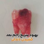 مراقبت بعد از کشیدن دندان,بهبود سریع بعد از کشیدن دندان,غذا بعد از کشیدن دندان,چای بعد از کشیدن دندان,