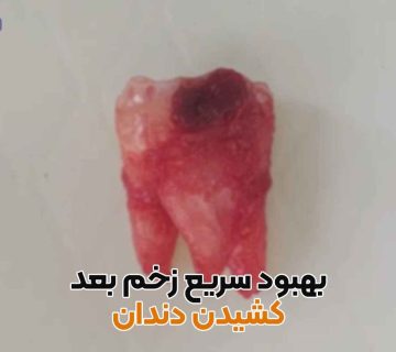 مراقبت بعد از کشیدن دندان,بهبود سریع بعد از کشیدن دندان,غذا بعد از کشیدن دندان,چای بعد از کشیدن دندان,