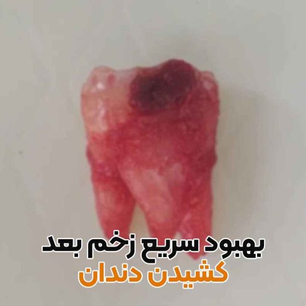 مراقبت بعد از کشیدن دندان,بهبود سریع بعد از کشیدن دندان,غذا بعد از کشیدن دندان,چای بعد از کشیدن دندان,