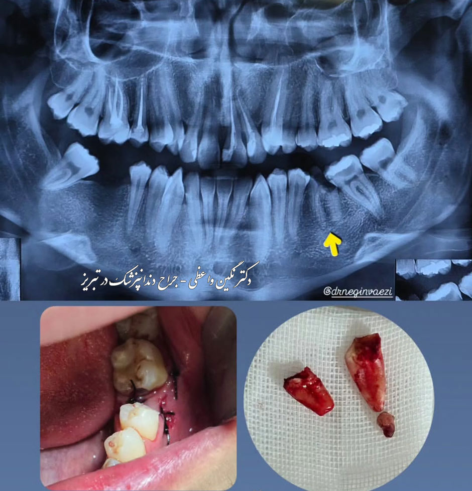 عکس جراحی دندان شکسته و پوسیده و عفونی شده قبل و بعد از جراحی - دکتر نگین واعظی - تبریز