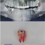 عکس جراحی دندان عقل عکس کشیدن دندان پوسیده و شکسته و خراب شده و عفونت کرده قبل و بعد جراحی دندان