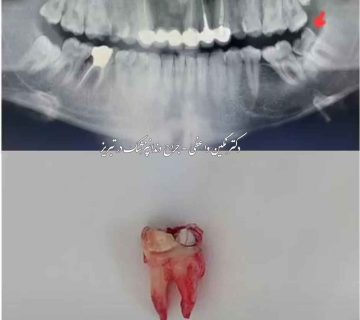 عکس جراحی دندان عقل عکس کشیدن دندان پوسیده و شکسته و خراب شده و عفونت کرده قبل و بعد جراحی دندان