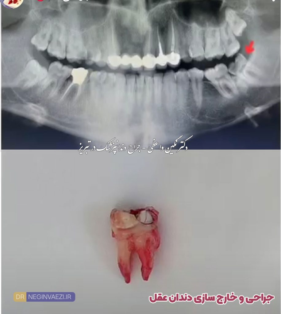 عکس جراحی دندان عقل و خارج سازی آن - دکتر نگین واعظی - تبریز