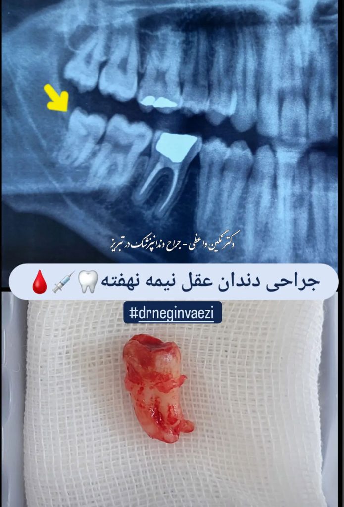 عکس جراحی دندان عقل نیمه نهفته همراه با رادیوگرافی - دکتر نگین واعظی - تبریز