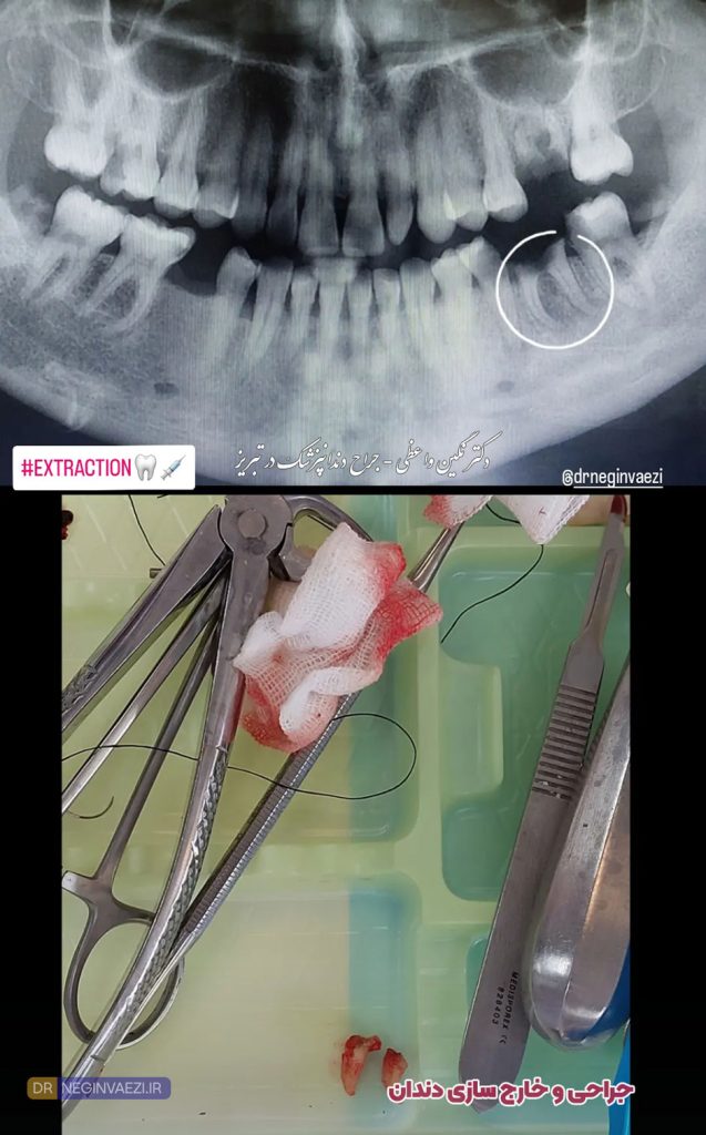 عکس جراحی و کشیدن دندان تخریب شده - دکتر نگین واعظی - جراح دندانپزشک در تبریز