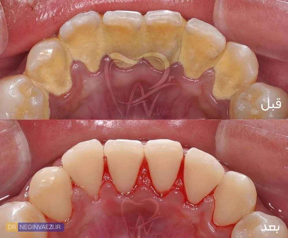 عکس جرم گیری دندان - جرم شدید که بصورت کامل سطح داخلی دندان و اطراف لثه بیمار را پوشانده است.