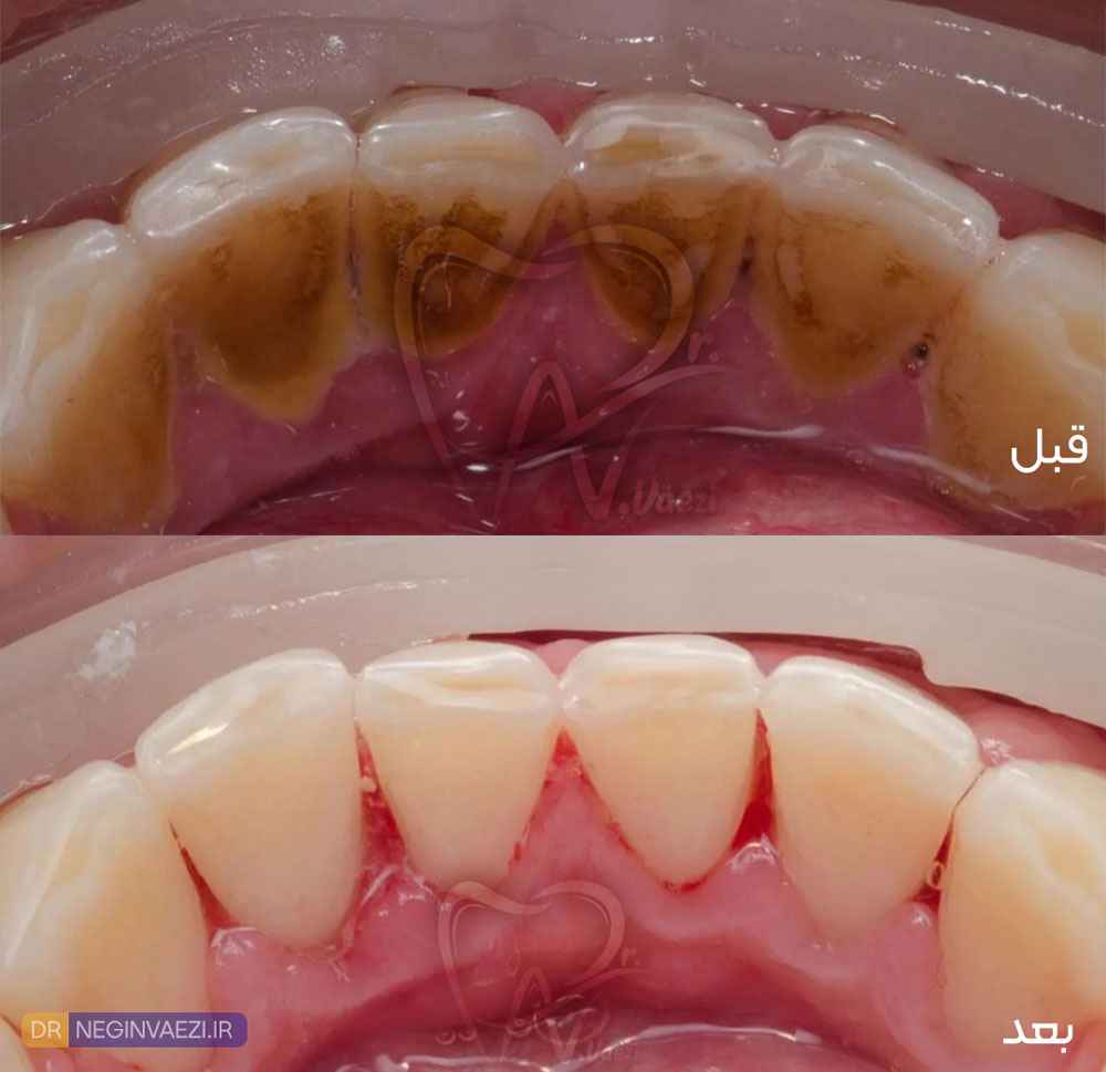 قبل و بعد جرم گیری دندان های به سطح داخلی قهوه ای رنگ