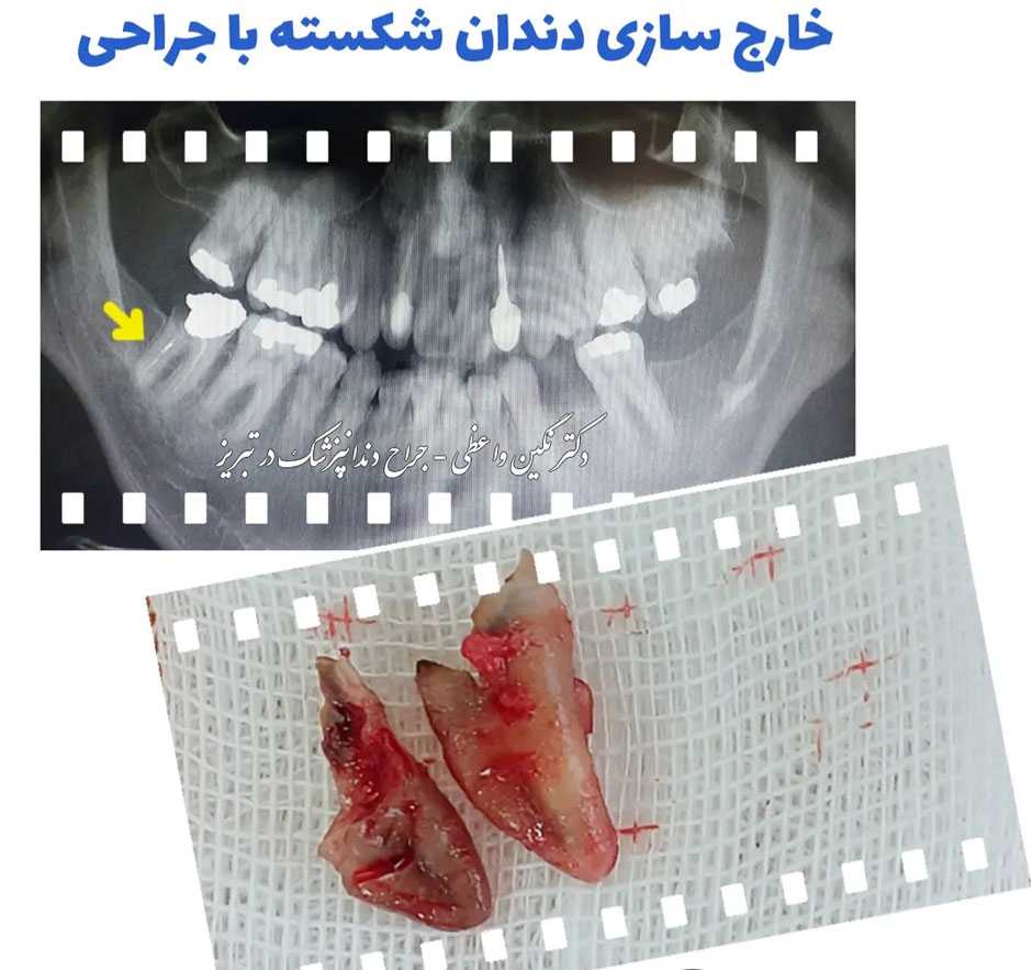 جراحی دندان شکسته و خارج سازی آن - دکتر نگین واعظی - جراح و دندانپزشک در تبریز