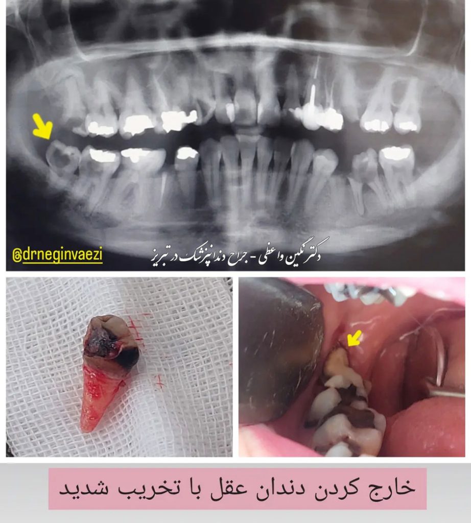 عکس جراحی دندان عقل پایین تخریب شده و خارج سازی آن - عکس قبل و بعد