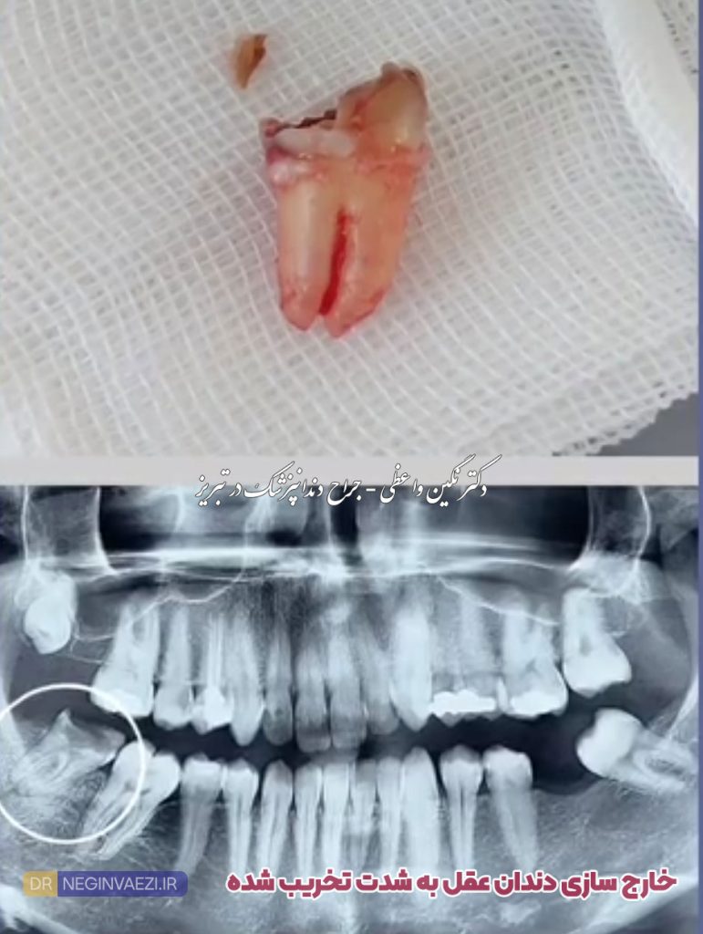 عکس از جراحی دندان عقل پایین تخریب شده - دکتر نگین واعظی