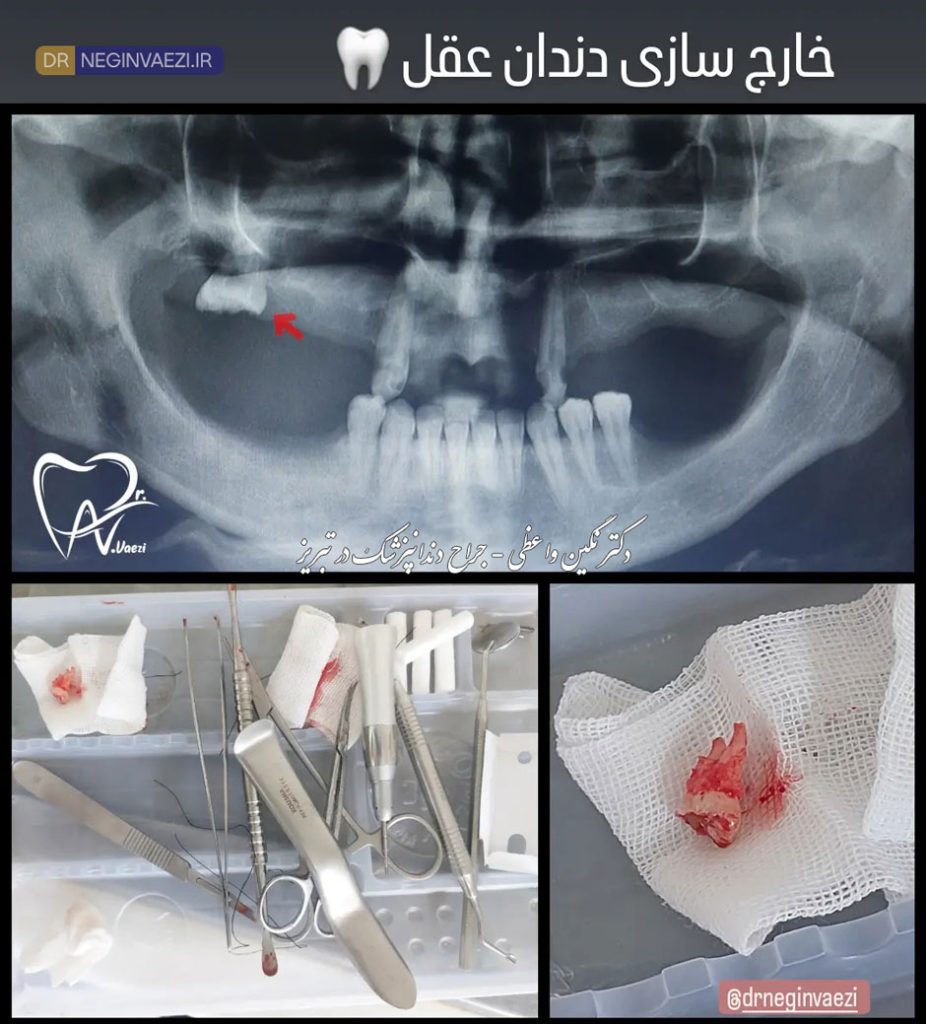 عکس کشیدن دندان عقل بالا - دکتر نگین واعظی