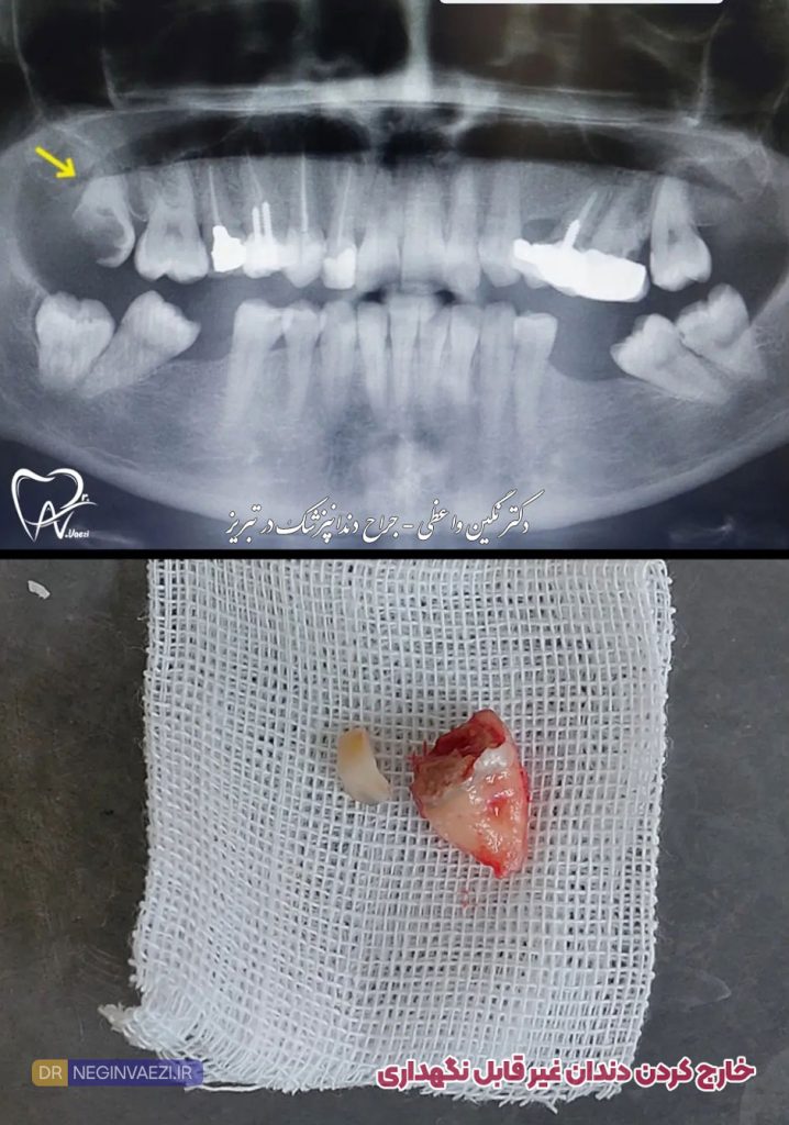 عکس کشیدن و خارج کردن دندان خراب - دکتر نگین واعظی