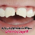 ترمیم کامپوزیت دندان,پرکردن دندان با کامپوزیت,پرکردگی کامپوزیت دندان,مراحل کامپوزیت دندان,طول عمر کامپوزیت,پوسیدگی دندان