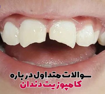 ترمیم کامپوزیت دندان,پرکردن دندان با کامپوزیت,پرکردگی کامپوزیت دندان,مراحل کامپوزیت دندان,طول عمر کامپوزیت,پوسیدگی دندان