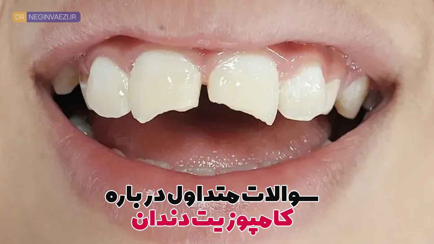 ترمیم کامپوزیت دندان,پرکردن دندان با کامپوزیت,پرکردگی کامپوزیت دندان,مراحل کامپوزیت دندان,طول عمر کامپوزیت,پوسیدگی دندان