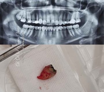 عکس قبل و بعد کشیدن دندان عقل فک بالا سمت راست - تبریز - دکتر نگین واعظی