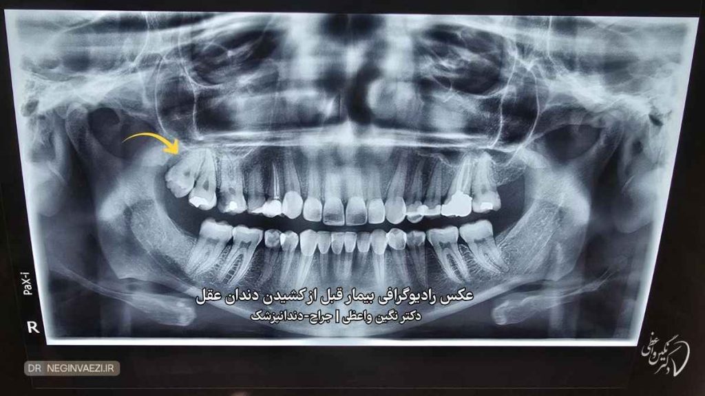 غکس پانورامیک opg قبل از کشیدن دندان عقل بیمار - دکتر نگین واعظی