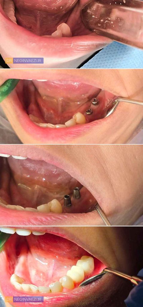 عکس قبل و بعد ایمپلنت دندان از بی دندانی تا کاشت ایمپلنت - نمونه کار فک پایین