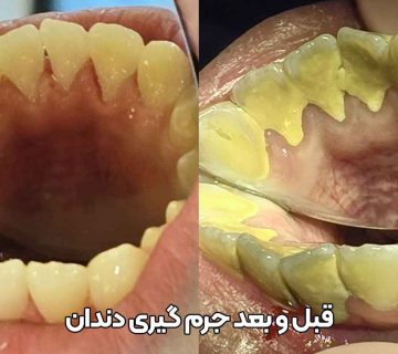 قبل و بعد جرم گیری دندان,عکس قبل و بعد از جرم گیری دندان,نمونه کار جرم گیری دندان در تبریز دکتر نگین واعظی