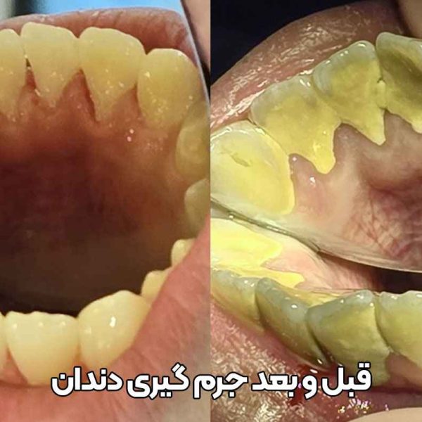 قبل و بعد جرم گیری دندان,عکس قبل و بعد از جرم گیری دندان,نمونه کار جرم گیری دندان در تبریز دکتر نگین واعظی