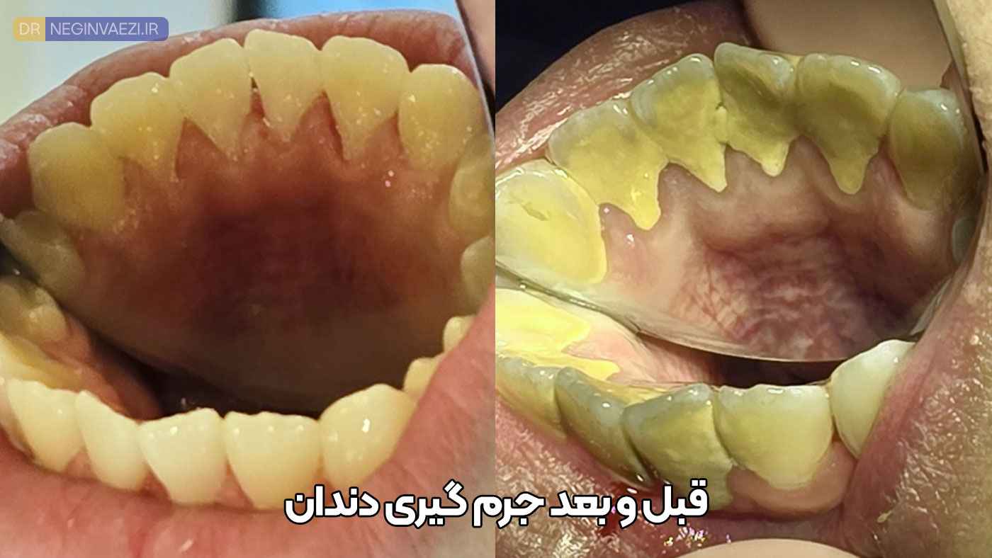 قبل و بعد جرم گیری دندان,عکس قبل و بعد از جرم گیری دندان,نمونه کار جرم گیری دندان در تبریز دکتر نگین واعظی