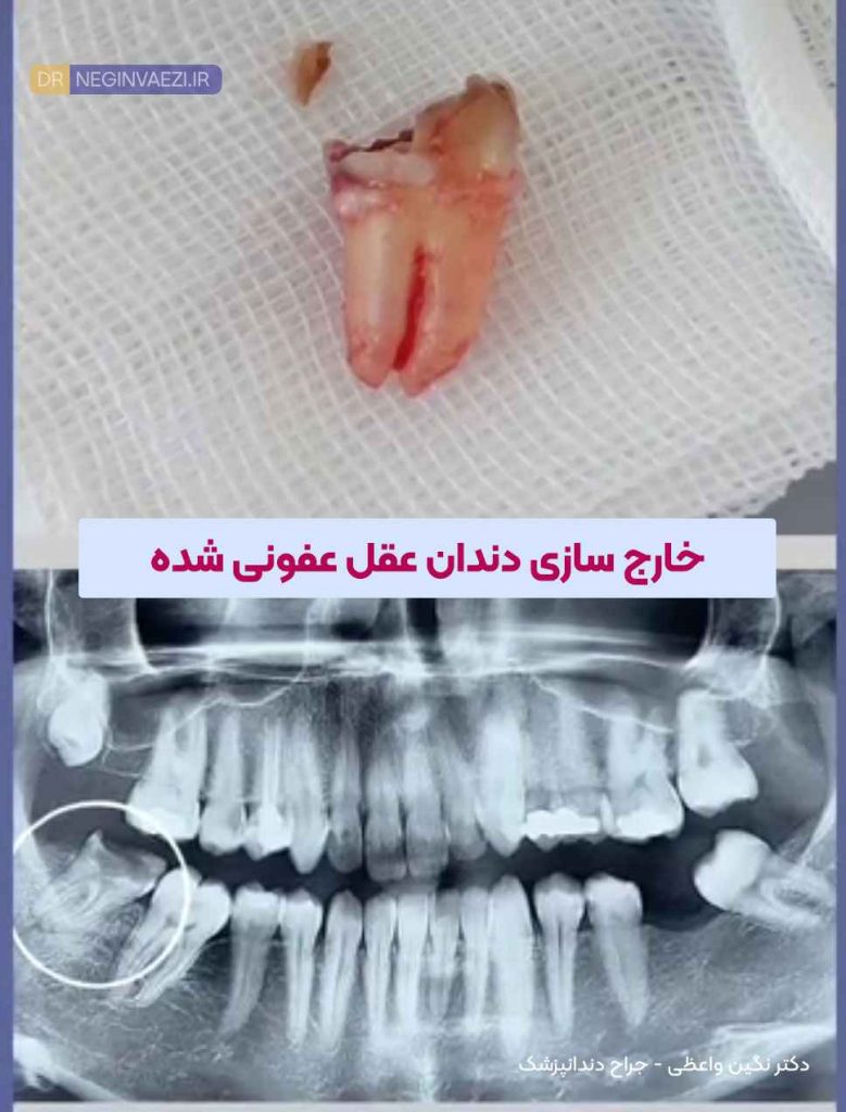 خارج سازی و کشدن دندان عقل عفونی شده با جراحی و بدون جراحی در تبریز توسط دکتر نگین واعظی